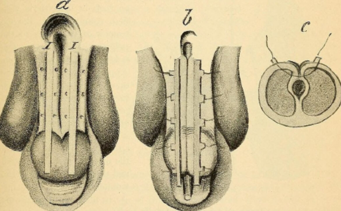 Extracorporeal shock wave lithotripsy
